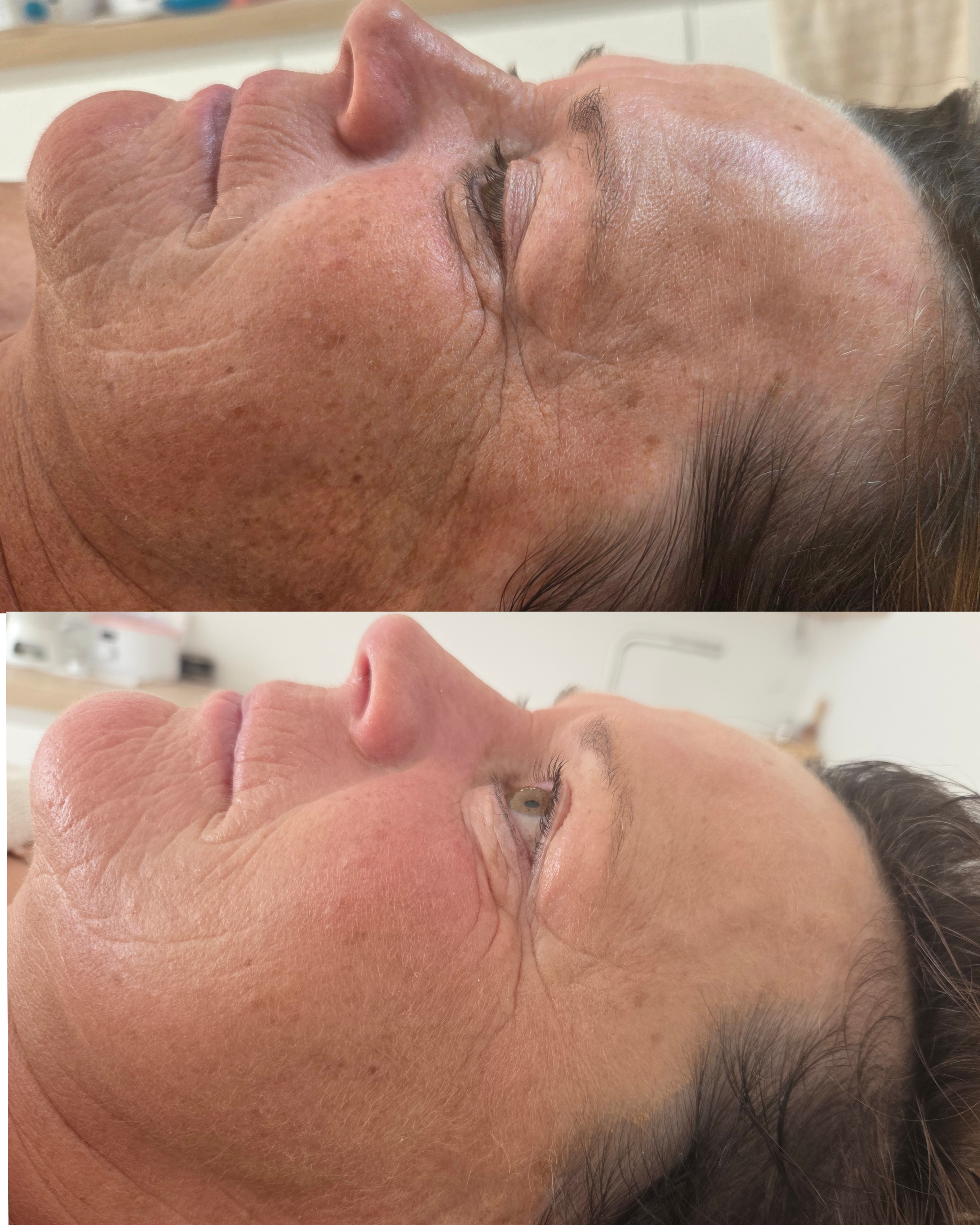 Photo complète du soin microneedling