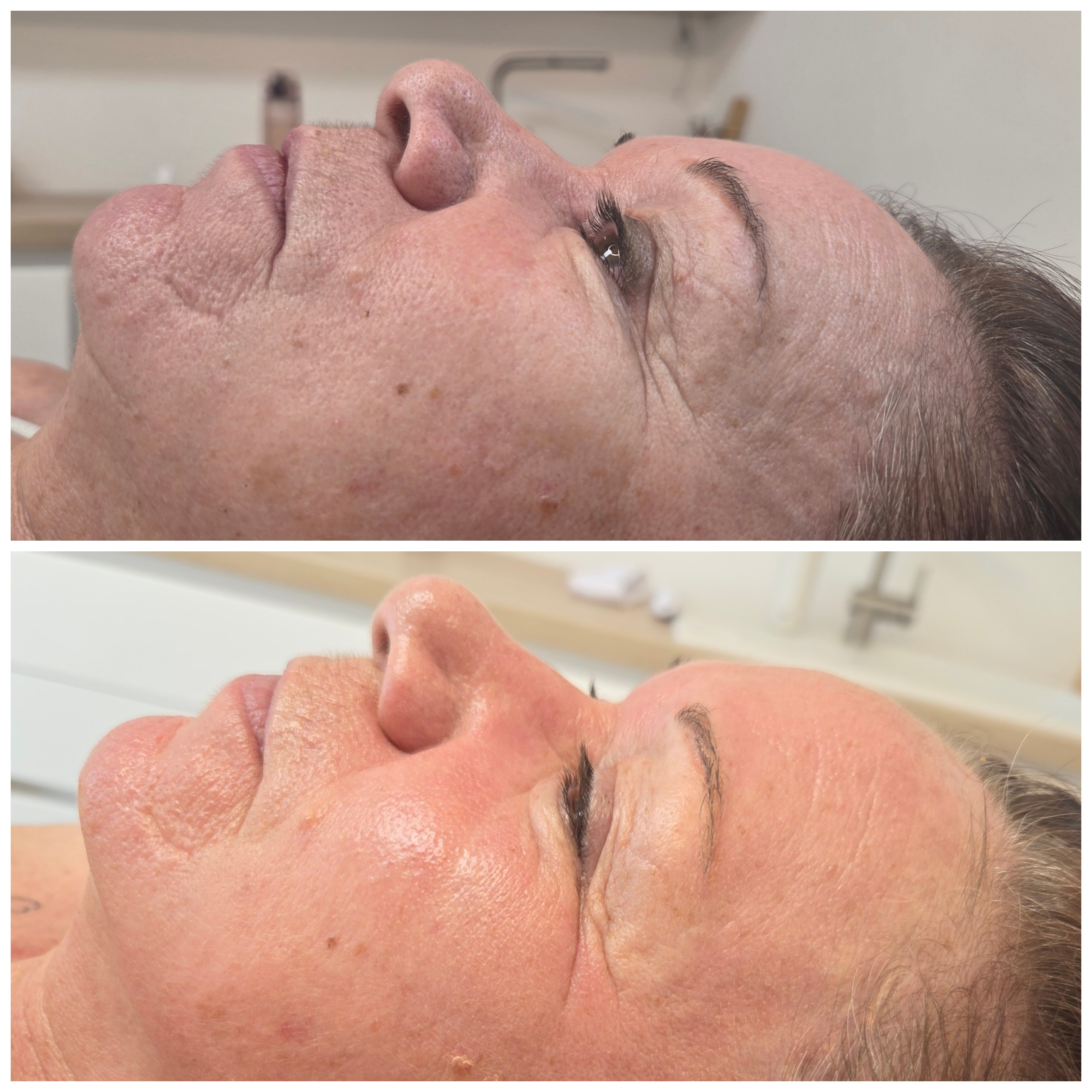 Avant-après du soin microneedling